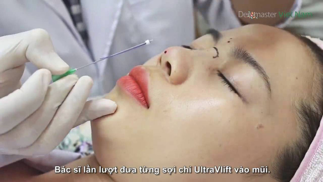 Nâng mũi không phẫu thuật với chỉ Ultra V Lift