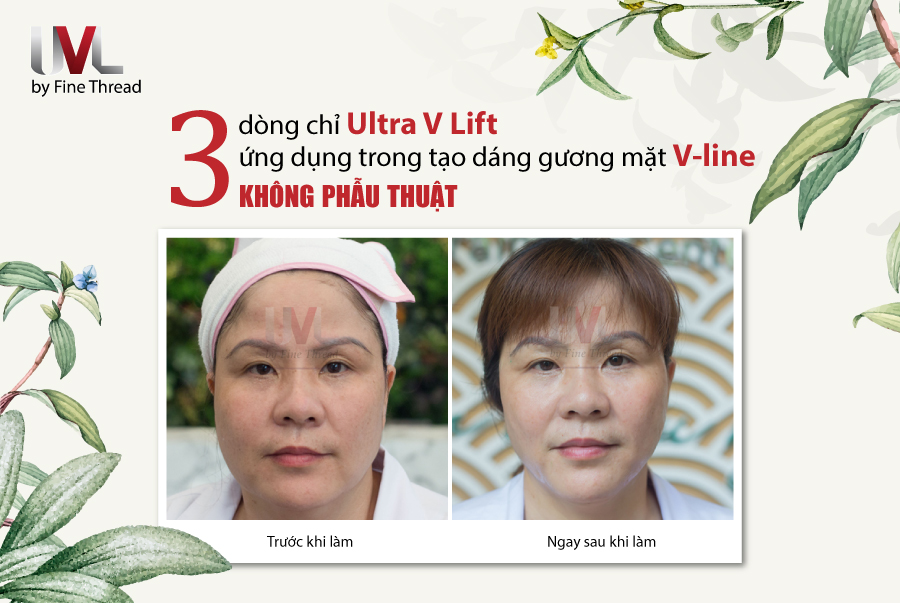3 dòng chỉ tạo dáng gương mặt V-line không phẫu thuật
