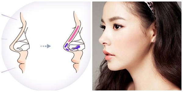 Phương pháp nâng cao mũi thông qua phẫu thuật