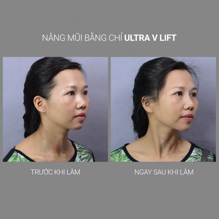 hình ảnh trước và sau khi nâng mũi bằng chỉ ultra v lift 1