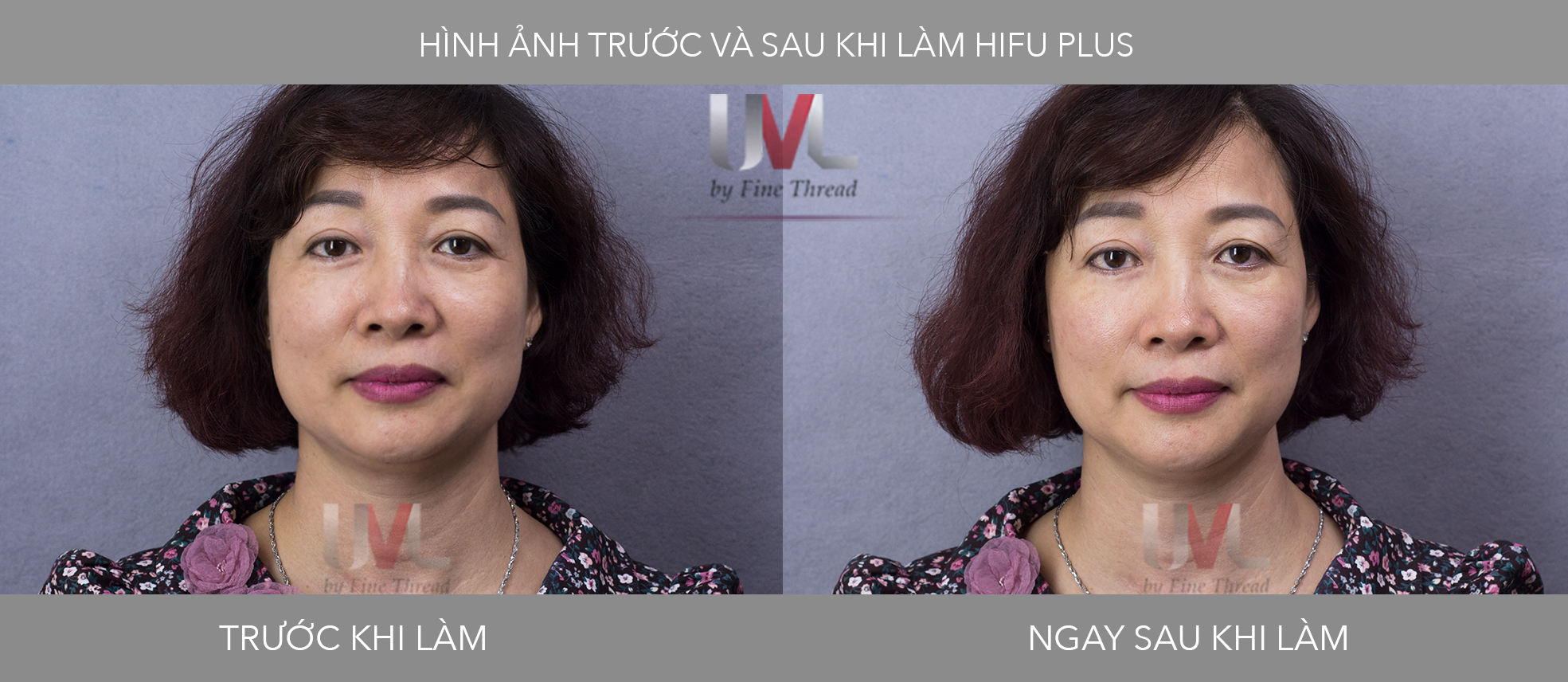 Hình ảnh khách hàng trước và sau khi làm hifu plus