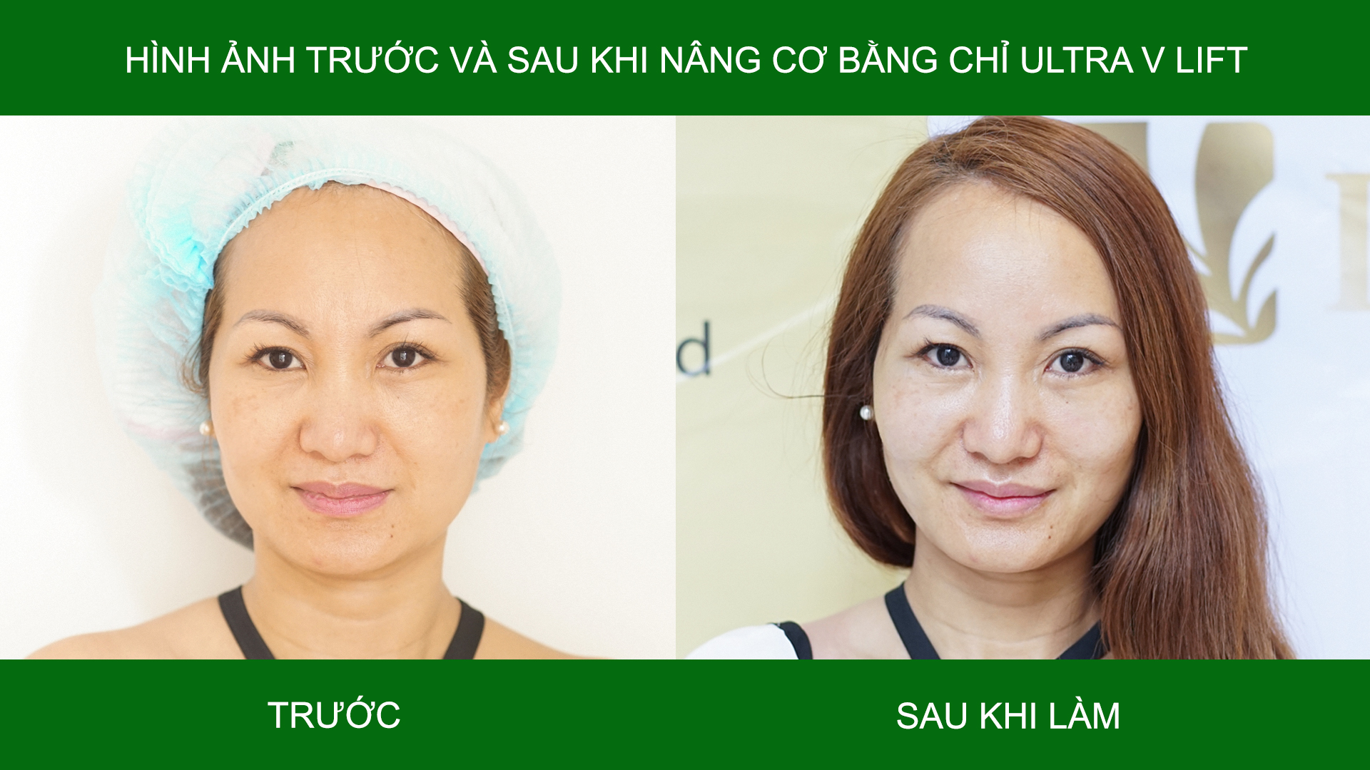 Hình ảnh trước và sau khi làm chỉ ultra v lift 3