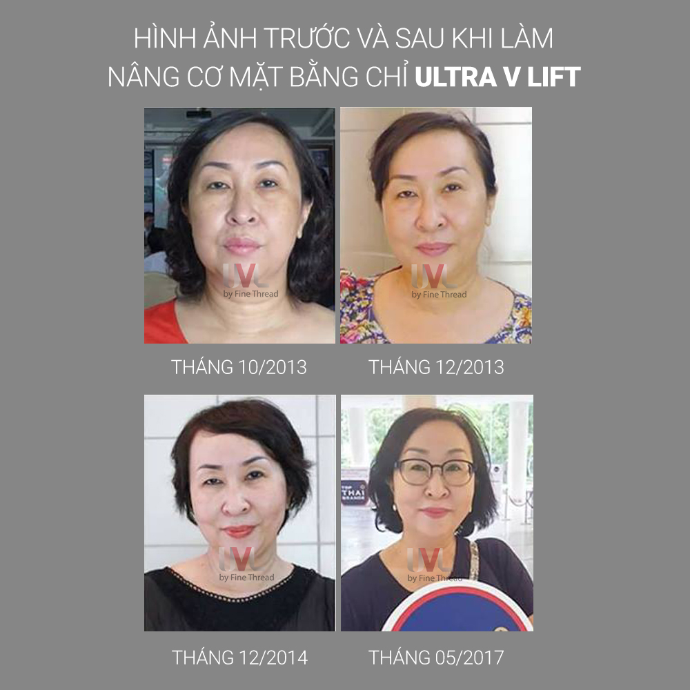 Ultra V Lift khắc phục được hầu hết các dấu hiệu lão hóa trên gương mặt