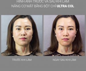 Trẻ hóa gương mặt với Filler Bột Chỉ Pdo Ultra Col