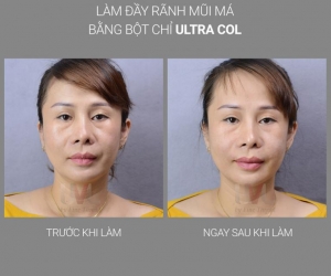 Trẻ hóa gương mặt với Filler Bột Chỉ Pdo Ultra Col