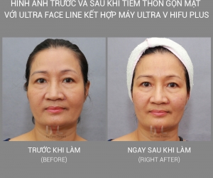 Tiêm thon gọn mặt với Ultra Face Line kết hợp với máy Ultra V Hifu Plus